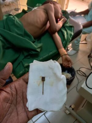 Article : Tchad : Un médecin sauve un enfant qui a avalé un gonfleur de ballon